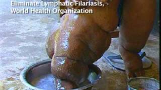 Elephantiasis Afflicts 120 Million in Africa Asia [upl. by Erodisi]