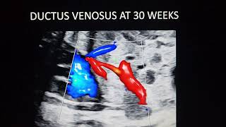 Agenesis of ductus venosusFetal echo teaching under REFER series by Dr Pradeep srinivasan [upl. by Nide]