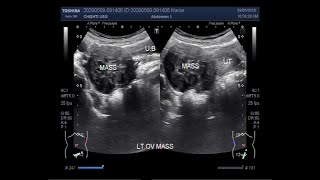 Ultrasound Video showing an Ovarian tumor [upl. by Atreb]