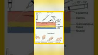 Route  technique of injection administration 💉knowledge easylearning shortsvideo shayari [upl. by Ned]