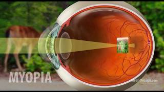 Myopia  Nearsightedness explained HD [upl. by Jt]