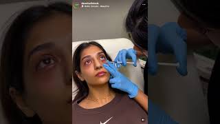 Dermis Clinic  Dark Circles pigmention darkeyes skincareroutine skincare manchester [upl. by Yrrehc952]