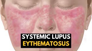 Systemic Lupus Eythematosus SLE Causes Signs and Symptoms Diagnosis and Treatment [upl. by Shatzer]