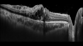 Treatment for Cystoid Macular Edema [upl. by Florrie950]