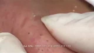 Highlight Professional blackhead popping at its best  GÀ SPA [upl. by Llertnor908]