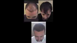 Time Lapse  18 months of hair loss treatment [upl. by Ecirtahs]