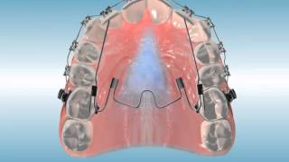 Nitanium® Palatal Expander²™ MultiPurpose Finishing Appliance [upl. by Neukam833]