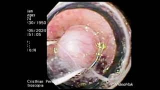 Ligadura Variceal  varices esofágicas  hemorragia digestiva alta [upl. by Innavoij]