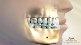 Orthodontic Treatment for Underbite or Crossbite  Carriere Appliance [upl. by Enrika]