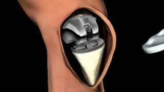 3D Medical Animation of a Knee Replacement [upl. by Macario294]