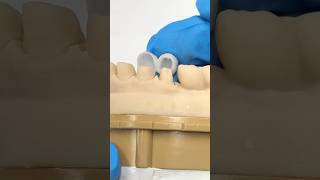 Four 2Unit Bridges ​⁠EnvisiontecMain envisiontec lsk121shorts dentist dentistteeth [upl. by Vallie]