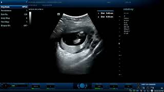 bicornuate gravid uterus 12wks pregnant woman Diagnostic ultrasound cases [upl. by Laurella]