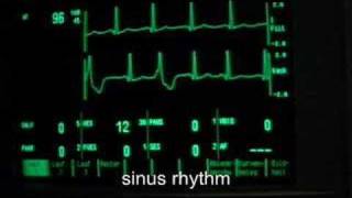 extrasystoles ventricular bigeminus [upl. by Oicneserc957]