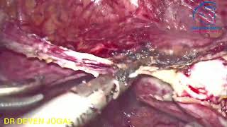 TLH IN PLASTERED UTERUS WITH ANTERIOR ABDOMINAL WALL previous abandoned laparotomy [upl. by Meek490]