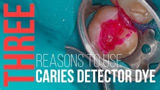 3 Reasons to Use Caries Detector Dye [upl. by Nordine]