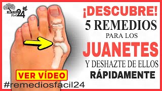 Descubre los 5 Remedios Caseros para los Juanetes y Deshazte de Ellos  Juanetes en los Pies [upl. by Wende]