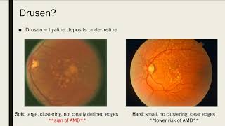 Vision Loss and Macular Degeneration [upl. by Gary493]