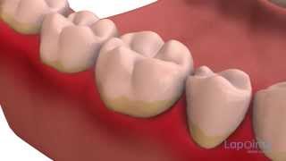 Dental plaque  Lapointe dental centres [upl. by Jeaz932]