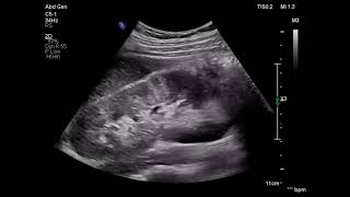 Acute pyelonephritis ultrasound patient with flank pain fever ARDMS sonography [upl. by Woll946]