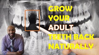 How To Grow Your ADULT Teeth Back Naturally 🦷 [upl. by Berty]