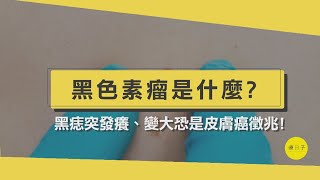 黑色素瘤是什麼？容易擴散轉移、致死率高！黑痣發癢、變大要小心【醫師在線等】 [upl. by Brom]