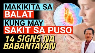 Makikita sa Balat kung May Sakit sa Puso 14 Signs na Babantayan  By Doc Willie Ong [upl. by Ellitnahc]