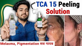 Tca 15 Chemical Peel Review  TCA 15 Peel How to Use  At Home Chemical Peel [upl. by Itsirk]