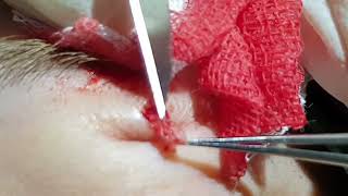 removing intradermal nevus [upl. by Pasia]