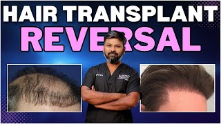 AskDrJohnWatts  HAIR TRANSPLANT REVERSAL  Hair Specialist Explains [upl. by Neron560]