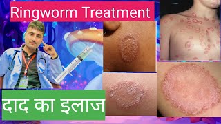 Ringworm Treatment  Fungal infection  दाद का इलाज  antifungal medicine [upl. by Eniawd]