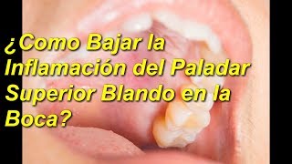 5 😮REMEDIOS NATURALES  Para El 😃PALADAR SUPERIOR BLANDO👀 [upl. by Yentnuoc]