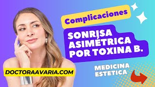 Sonrisa Asimétrica por Toxina Botulínica [upl. by Tichon]