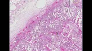 Histopathology Lung Lobar pneumonia [upl. by Sida]