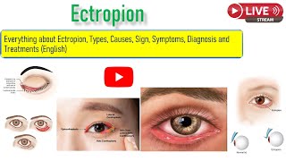 Everything about ectropion Types Sign Symptoms and Treatment option including surgury [upl. by Netti]