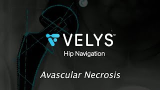 VELYS Hip Navigation for Avascular Necrosis with a DEPUY BIMENTUM Dual Mobility Cup [upl. by Hymen85]