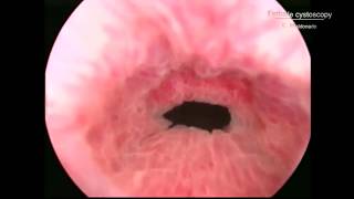 Female cystoscopy with dupplicated ureter Right side [upl. by Dovev540]