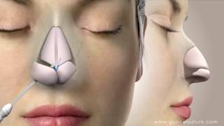 Rhinoplasty Nose Job Video Animation  Guncel Ozturk MD  DRGO [upl. by Elorak517]