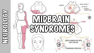 Midbrain Syndromes  Weber’s Syndrome Benedikt’s Syndrome and Parinaud Syndrome [upl. by Johanna]