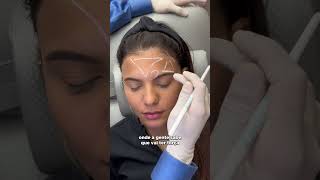 Técnica de botox para arqueamento de sobrancelha [upl. by Yesnikcm139]