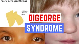 DiGeorge Syndrome  Pathology Clinical Presentation Diagnosis amp Treatment [upl. by Trovillion]