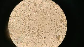 RBCs with epithelial cells in Urine Sample كرات الدم فى البول [upl. by Iek]