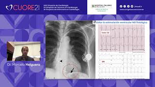 Estimulación del Sistema de Conducción con el Dr Marcelo Helguera  CUORE21 [upl. by Crenshaw]