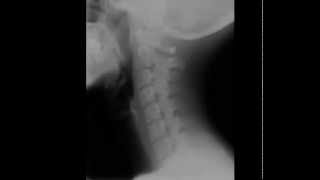 Cervical Spine Radiology Tutorial [upl. by Ennovy]