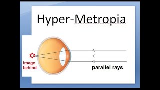 Ophthalmology 044 b HyperMetropia HyperOpia long sightedness Shot silk appearance pseudopapillitis [upl. by Caughey]