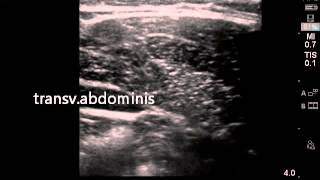 Ultrasound guided transversalis fascia plane block [upl. by Swann630]