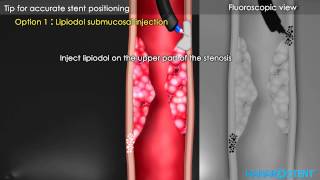 Hanaro Oesophageal Stents Demonstration Video [upl. by Flight]