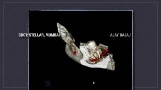 HOW TO MANAGE CURVED CANAL CASES [upl. by Aiuoqes193]