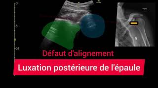 Luxation Postérieure de lÉpaule Échographie Glénohumérale Posterior shoulder dislocation [upl. by Einnol887]