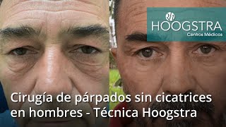 Cirugía de párpados sin cicatrices en hombres  Técnica Hoogstra 22029 [upl. by Huoh836]