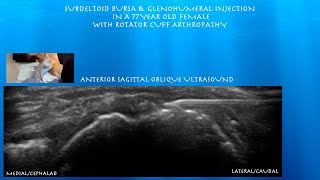 Ultrasound Guided Subdeltoid Bursa Glenohumeral injection in a Female with Rotator Cuff Arthropathy [upl. by Ierdna]